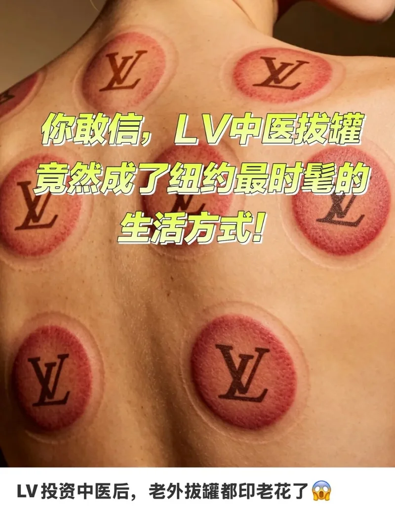 白人中产新标准:有钱拔罐