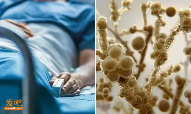 全球致命真菌加速蔓延 死亡率最高可达70%