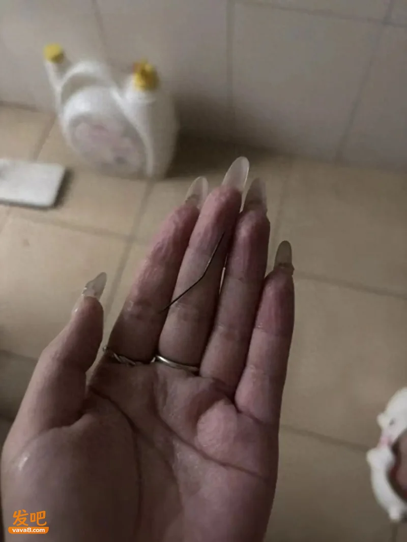 浙江女子左臀疼了一个月 洗澡时竟挤出一根已发黑的注射针头