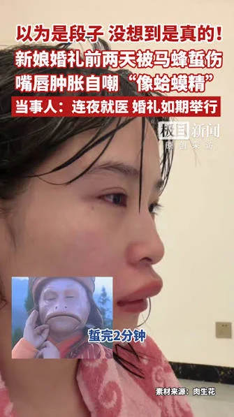 新娘婚礼前两天被马蜂蜇伤 嘴唇肿胀自嘲“像蛤蟆精”